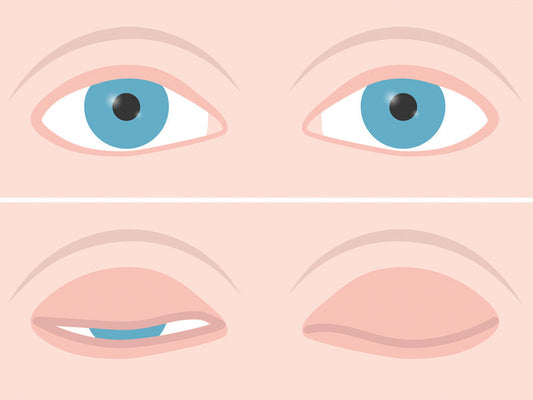 Dry Eye Strategies for Those with Lagophthalmos