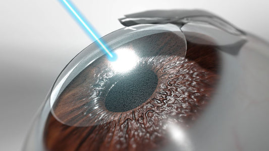 Dry Eye after Lasik