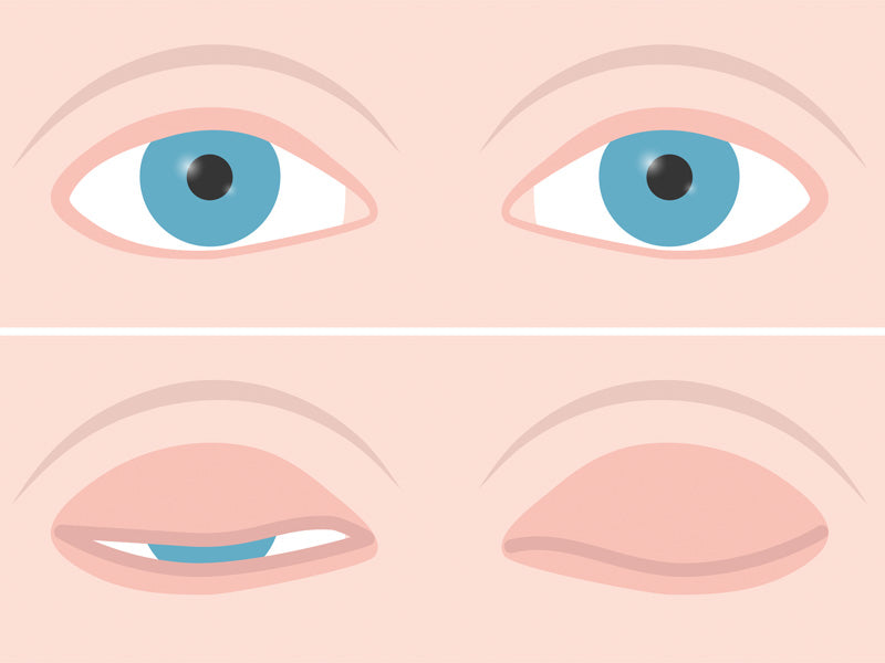 Dry Eye Strategies for Those with Lagophthalmos